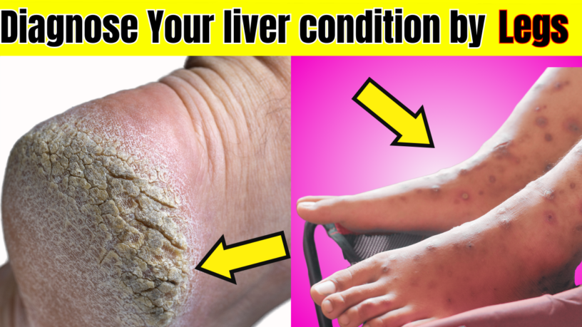 Dangerous Hidden Signs in Your Legs That Indicates Liver Problems