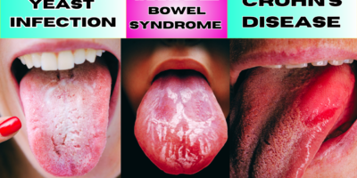 7 Signs of Tongue you should look out for