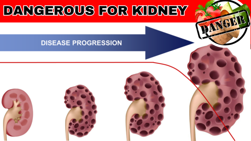 High Potassium Foods to Avoid with Kidney Disease