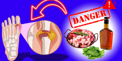 Avoid these Foods If you have Gout: